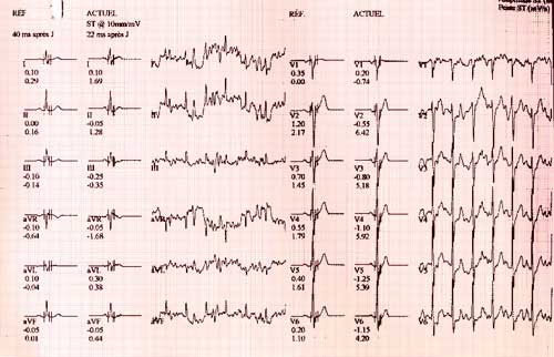 électrocardiogramme du test d'effort